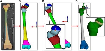 Intra- and inter-subject variability of femoral growth plate stresses in typically developing children and children with cerebral palsy